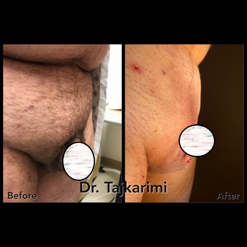 Mons Pubis Liposuction Groin Fat Pad - Castleknock Cosmetic Clinic